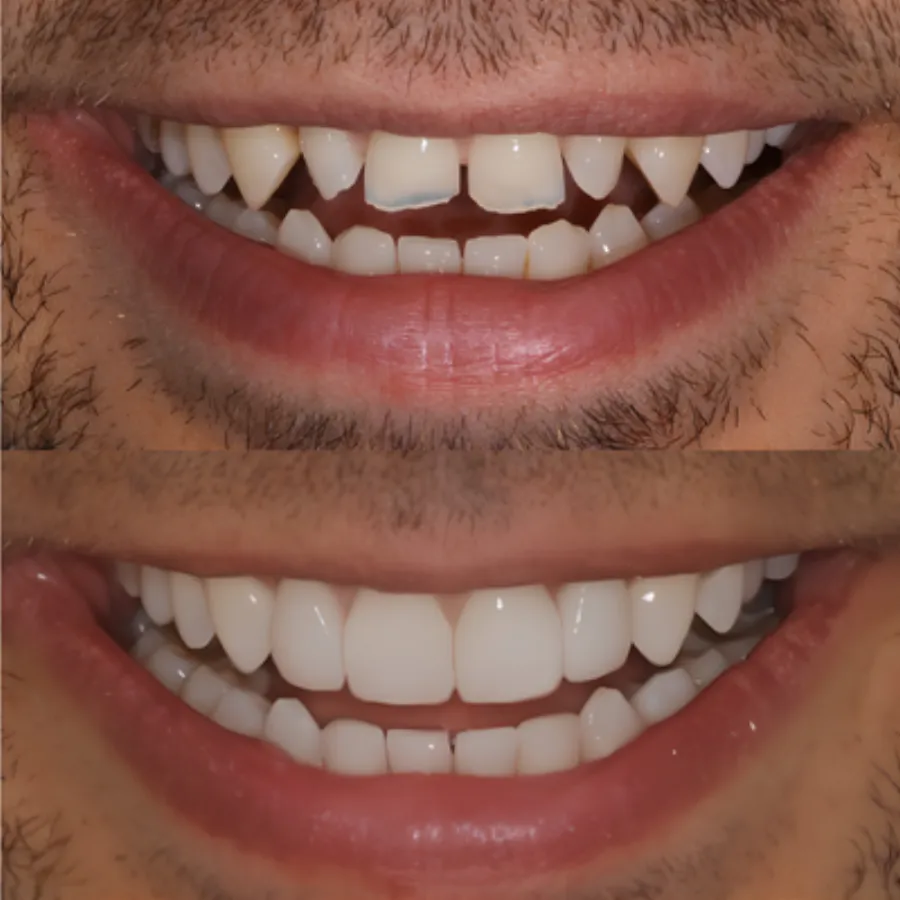 Invisalign before and after result at J&R Dental (patient 2)