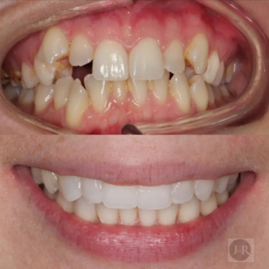 Invisalign before and after result at J&R Dental (patient 1)
