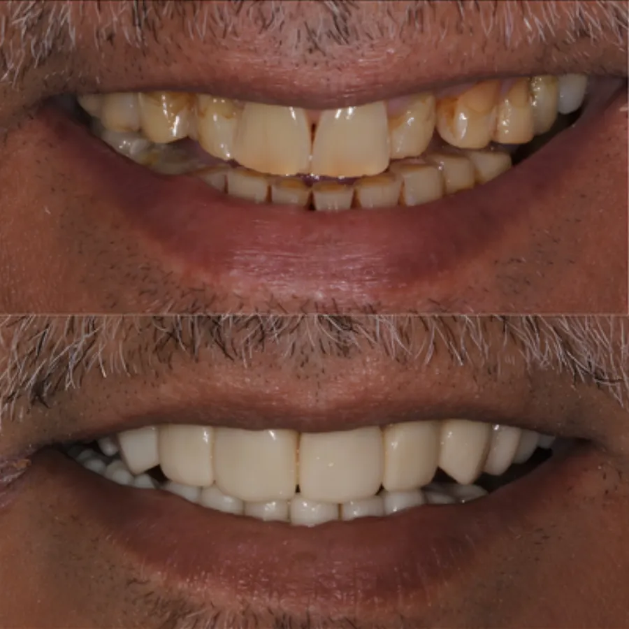 Invisalign before and after result at J&R Dental (patient 3)