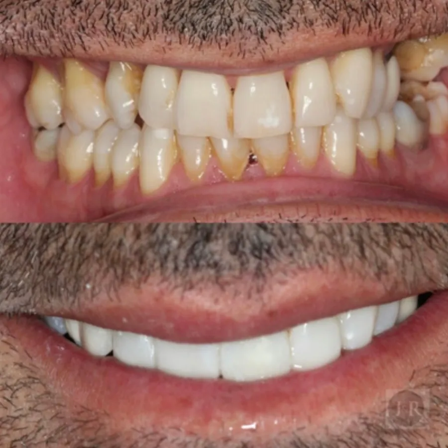 Invisalign before and after result at J&R Dental (patient 4)