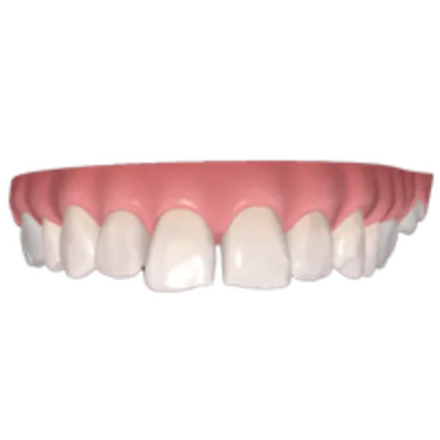 Illustration of teeth suited to Invisalign Express Invisalign treatment