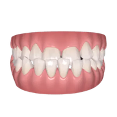 Illustration of teeth suited to Comprehensive Invisalign treatment